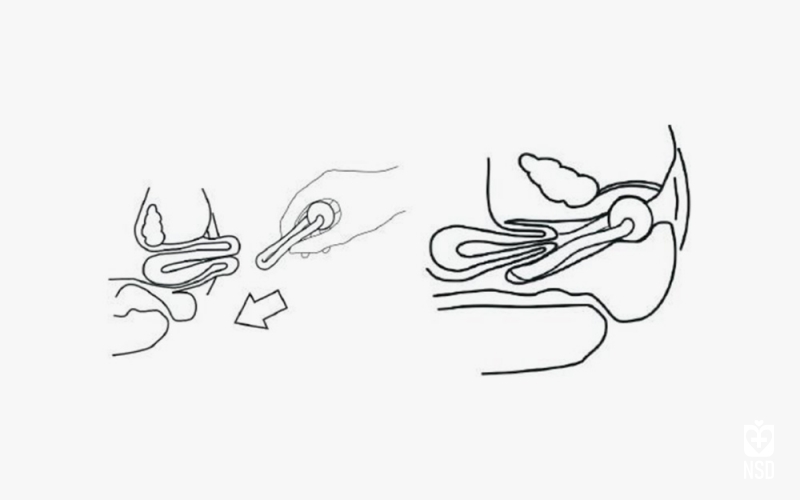 Silicone Pessary Urethral