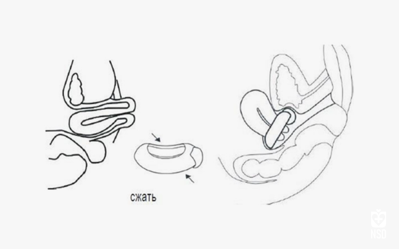 پساری &zwnj;Bowl Shaped Urethral