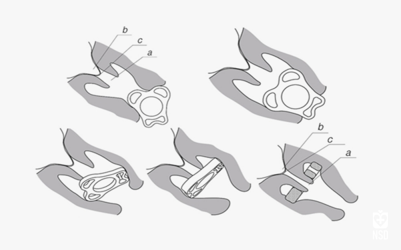 Silicone Disposable Obstetrical Pessary